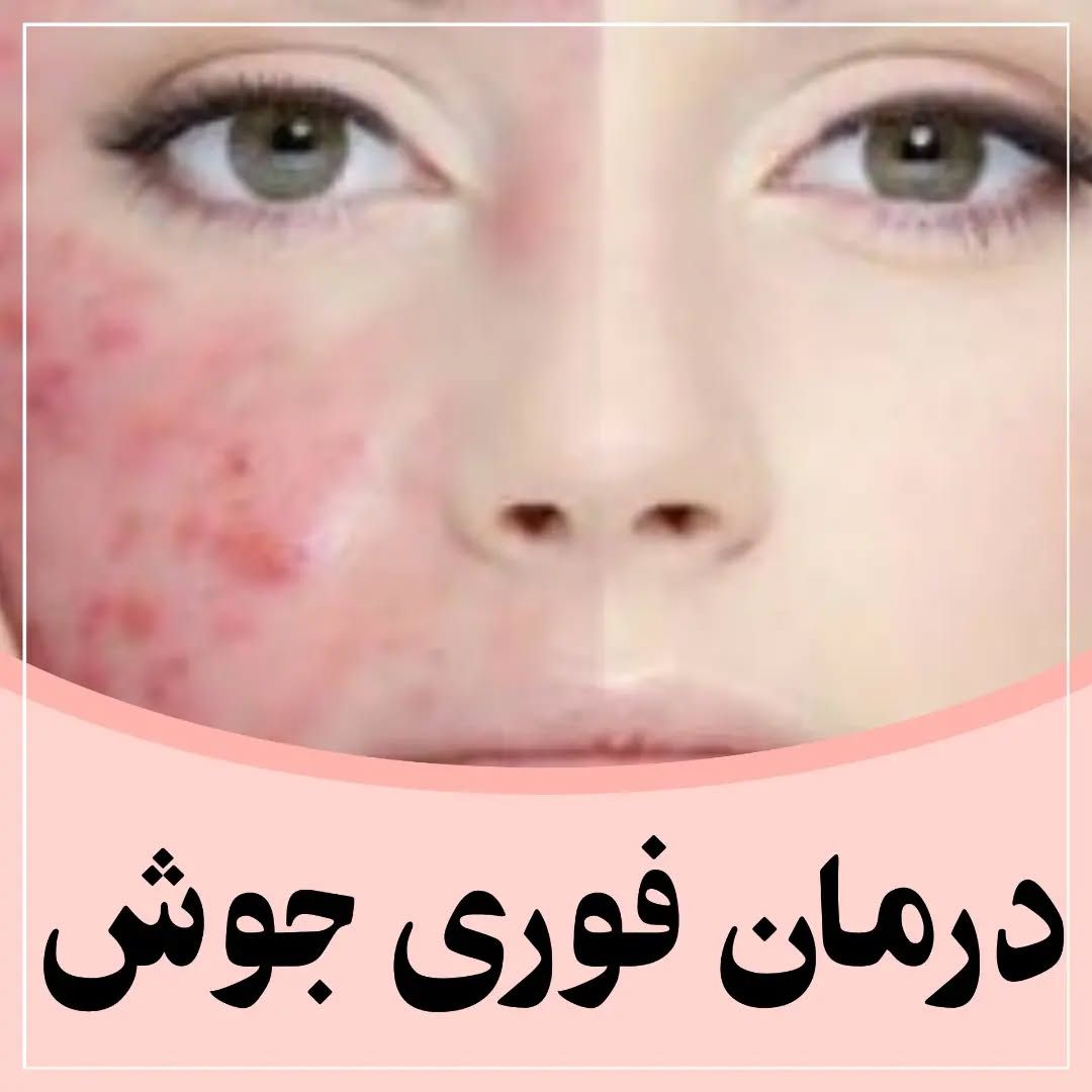 ترکیب پاکسازی عمیق پوست و درمان جوش های عفونی و زیر پوستی
